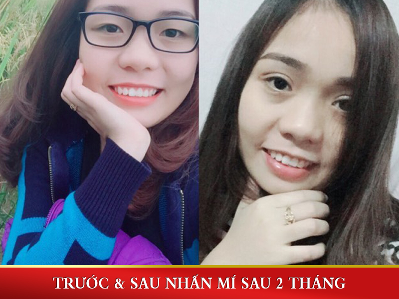 Hình ảnh trước và sau khi nhấn mí mắt sau 2 tháng